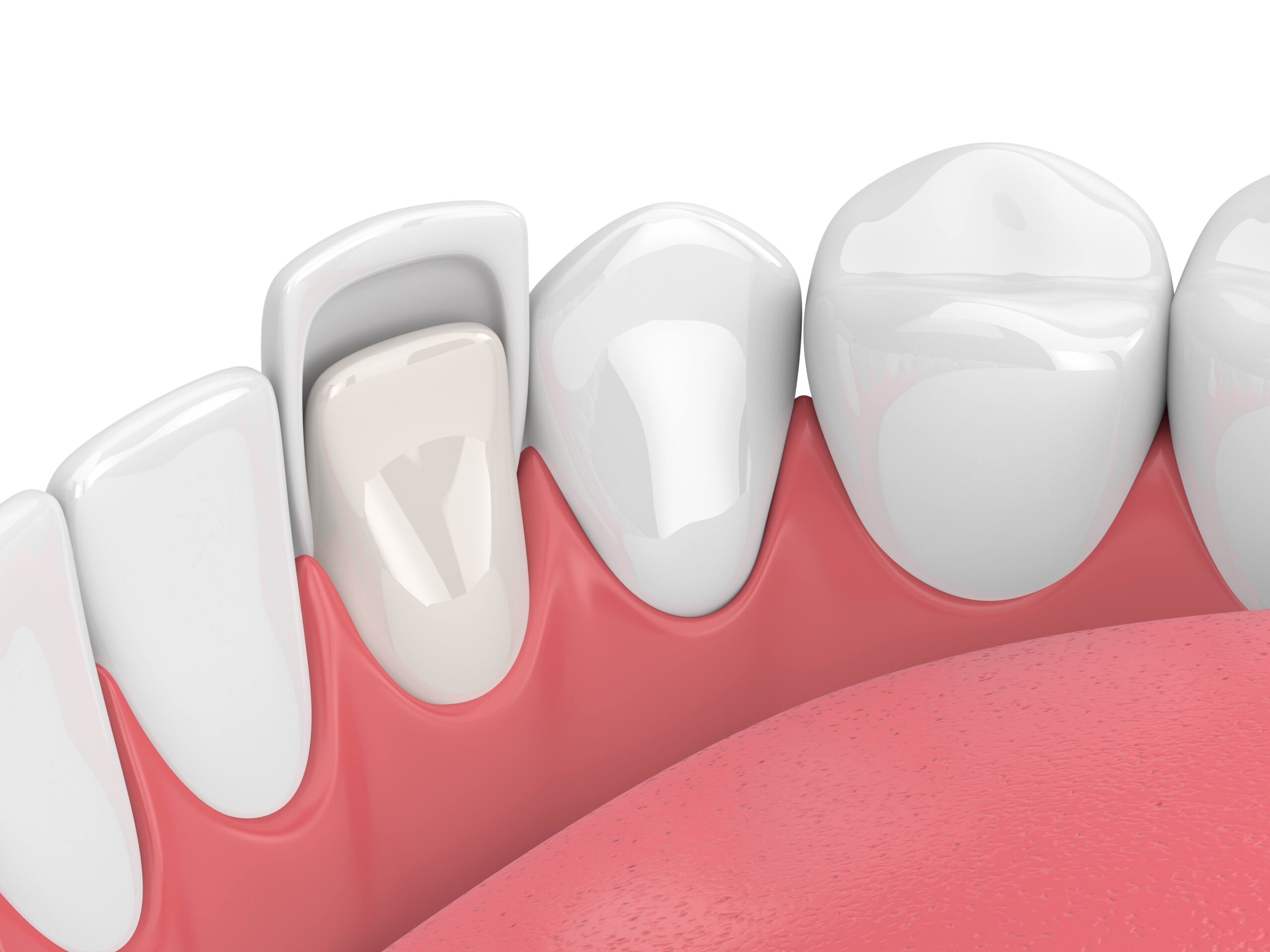 Dental veneers image