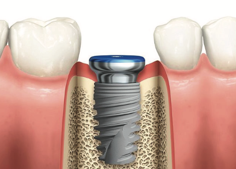 implant image 1