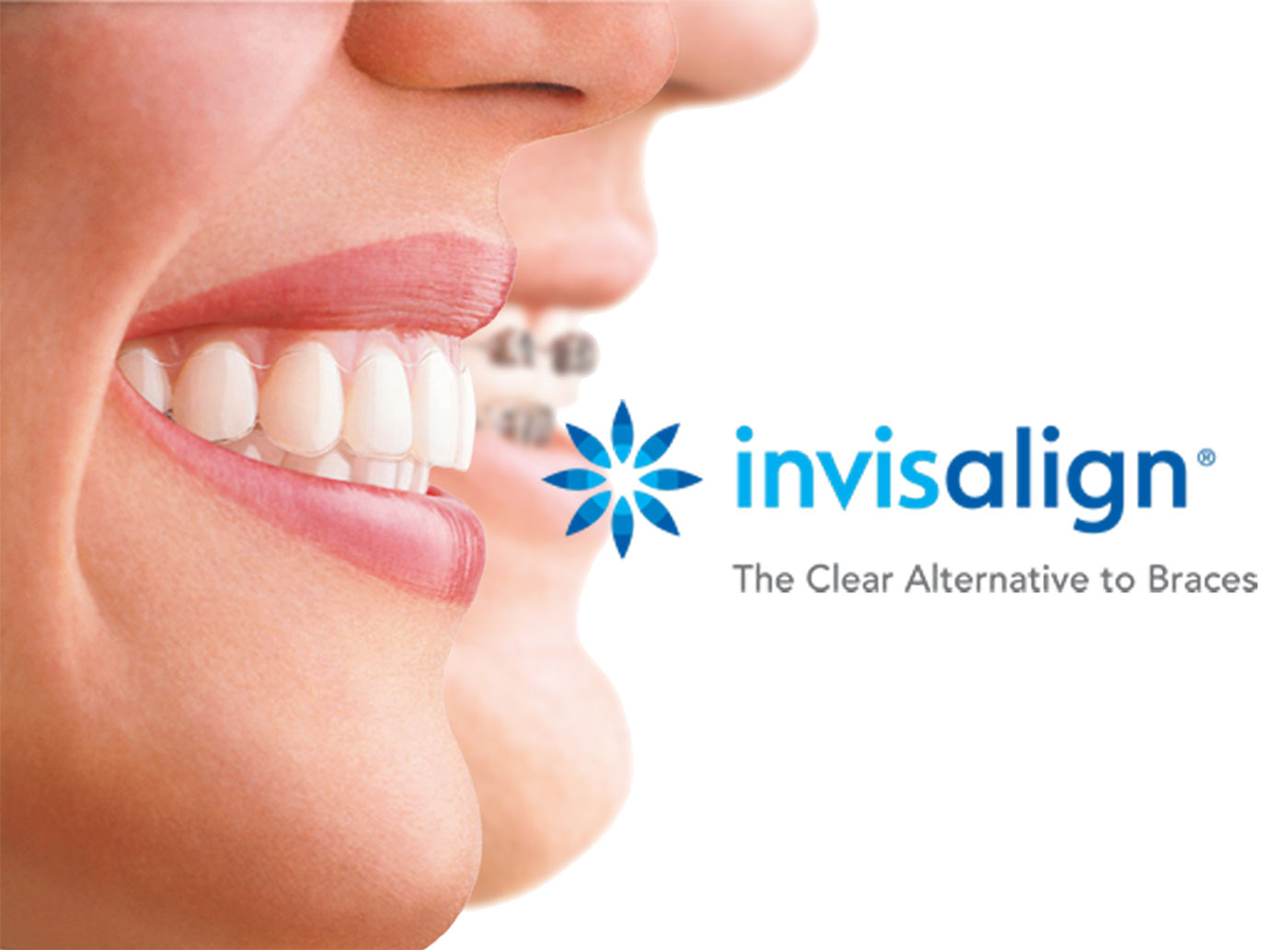 invisalign-image-2